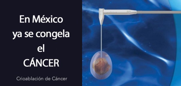 crioablacion